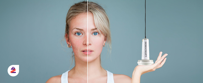 قبل و بعد از استفاده از دموکرافت بر روی پوست صورت یک خانم