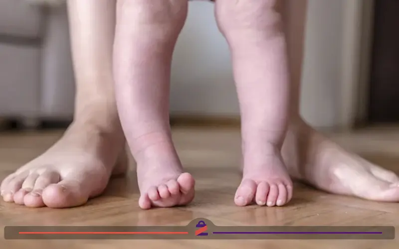 درمان پای پرانتزی در کودکان