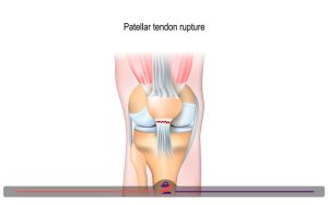 پارگی تاندون زانو