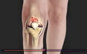 آنوتومی خشکی زانو