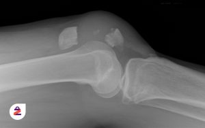 رادیولوژی شکستگی مفصل زانو