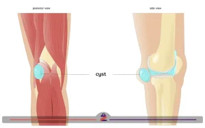 کیست مینیسک زانو آنوتومی