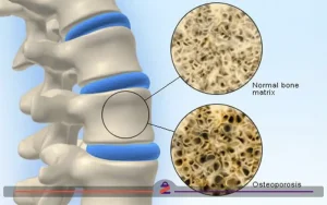 تصویری از آنوتومی پوکی استخوان