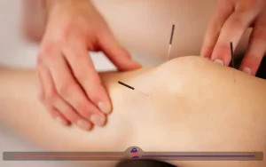 طب سوزنی برای زانو