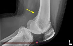 عکس رادیولوژی خار زانو