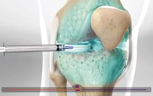 تزریق استروئید در زانو