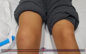 بیماری که دچار دررفتگی زانو شده است