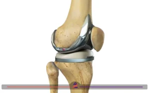 ساختار پلاتین در زانو