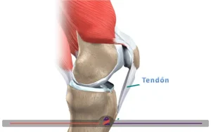 درمان کشیدگی تاندون زانو
