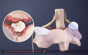 فیزیوتراپی تنگی کانال نخاعی