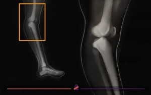 عکس MRI عقب زدگی زانو