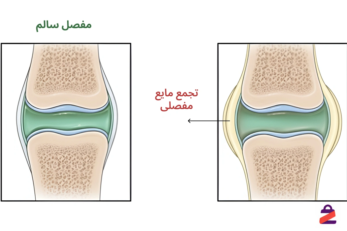 آب آوردن زانو خطرناک است