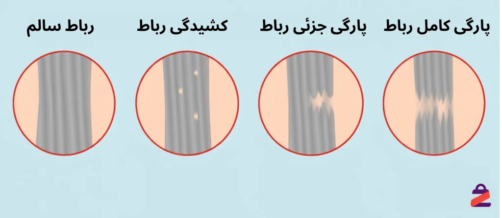 تفاوت پارگی و کشیدگی رباط زانو