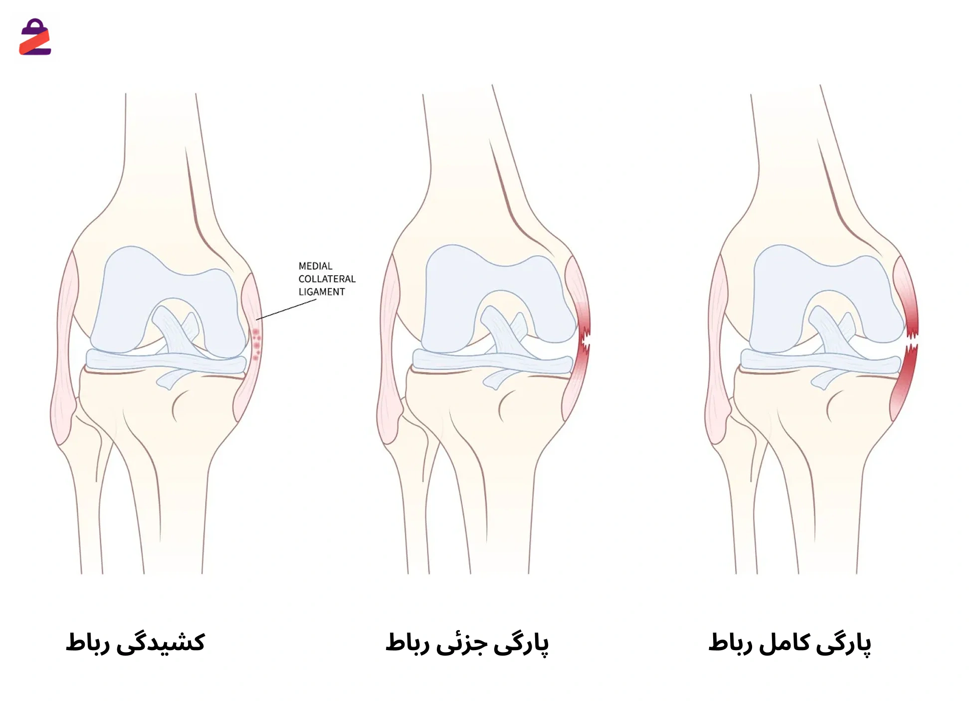 عکس پارگی رباط و کشیدگی رباط