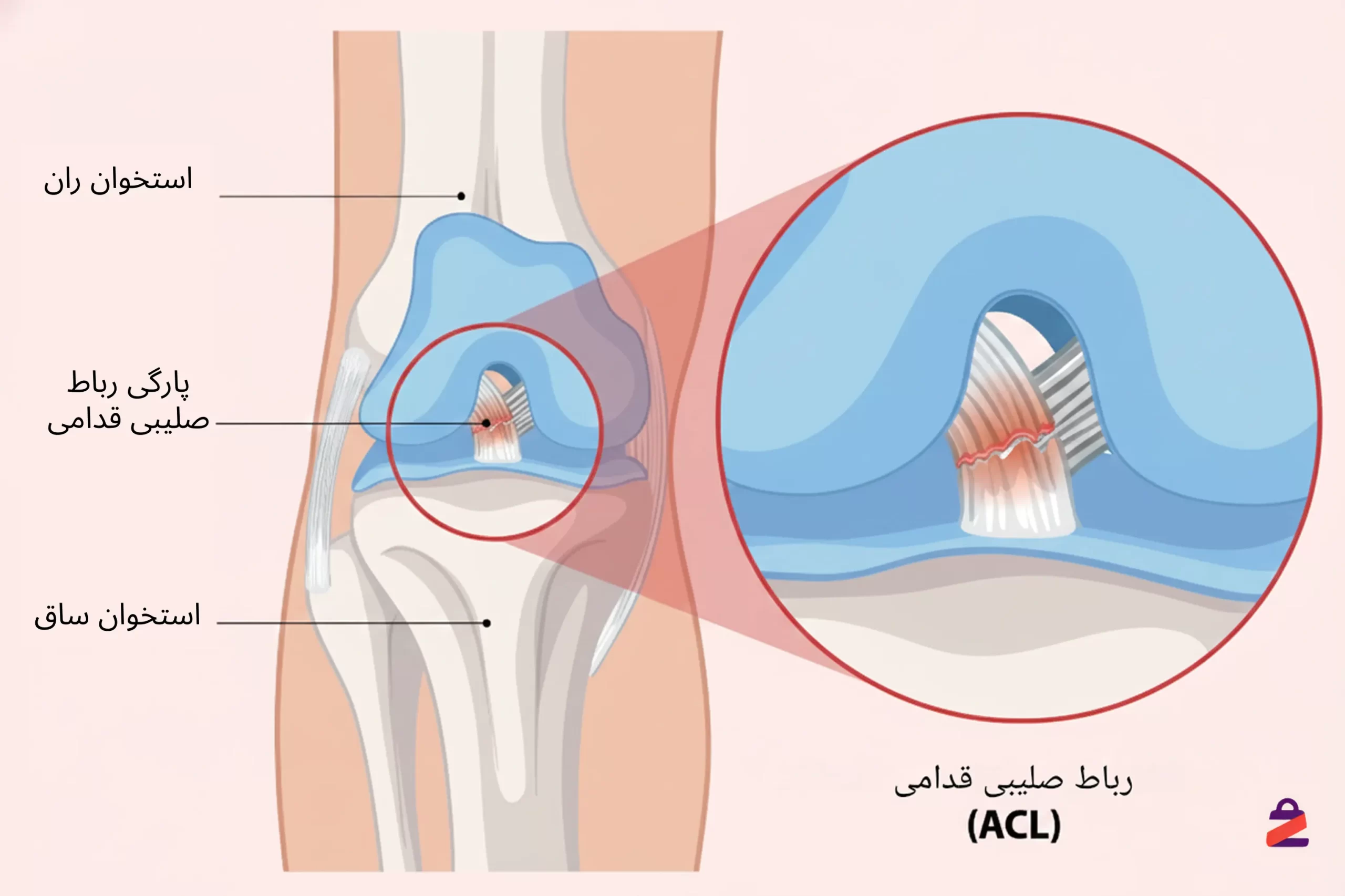 پارگی رباط صلیبی