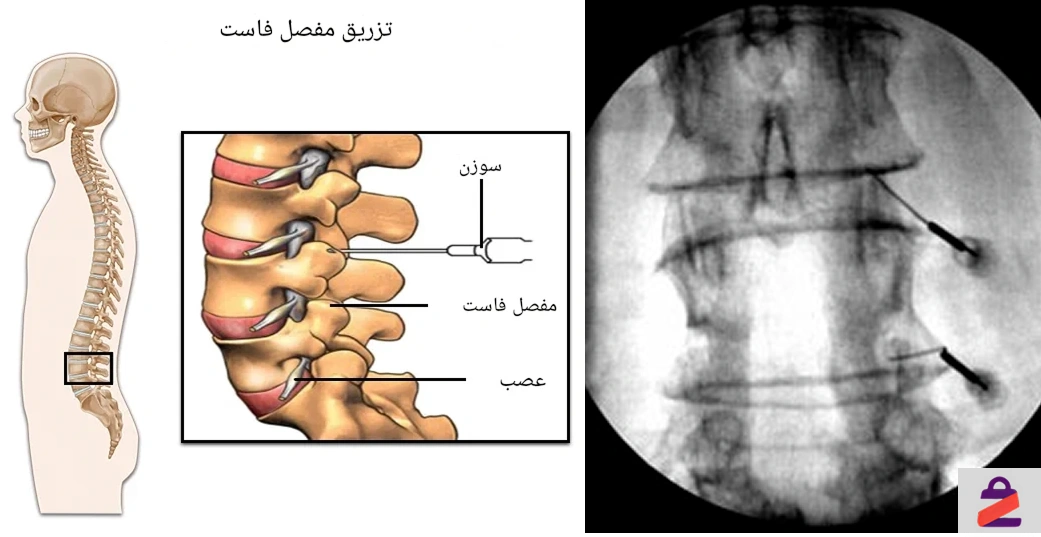 تزریق مفصل فاست برای تنگی کانال نخاعی