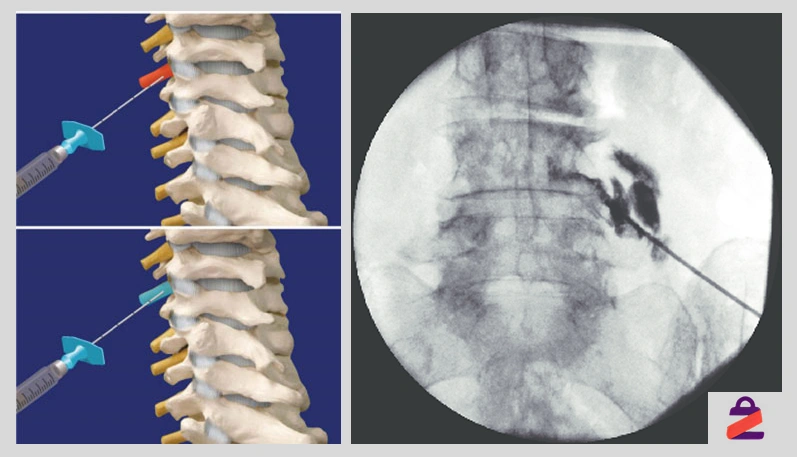 تزریق بلوک عصبی برای تنگی کانال نخاعی