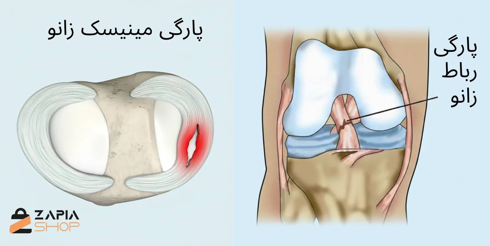 تفاوت پارگی رباط با مینیسک زانو