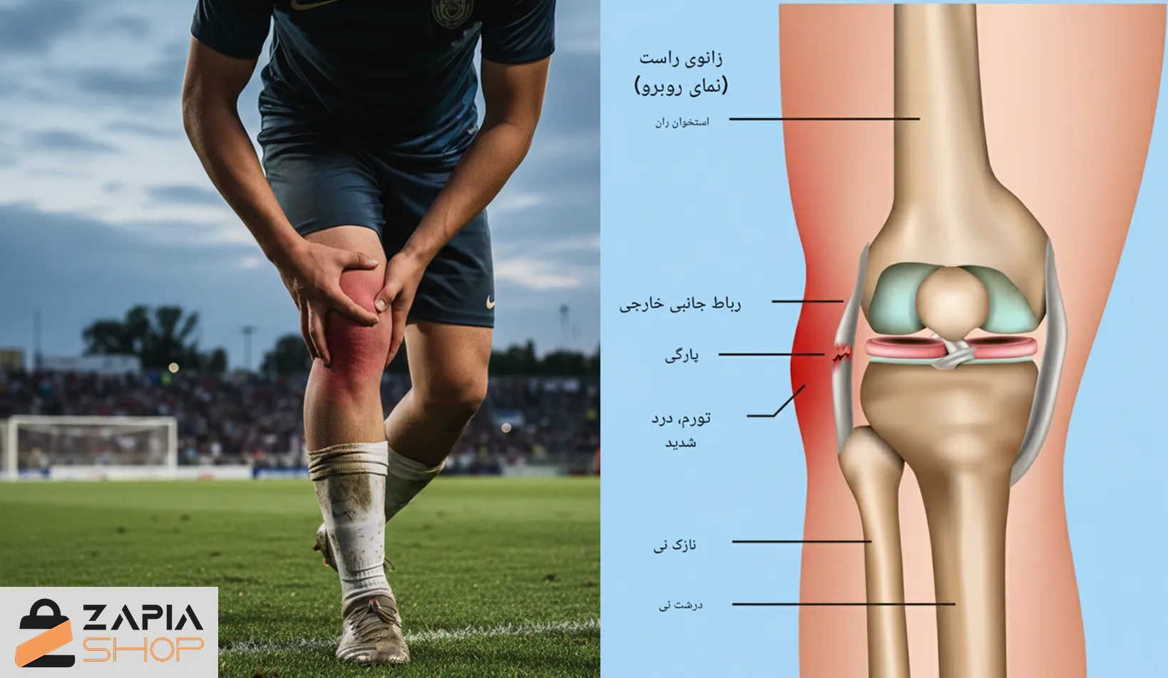 علائم پارگی رباط جانبی زانو