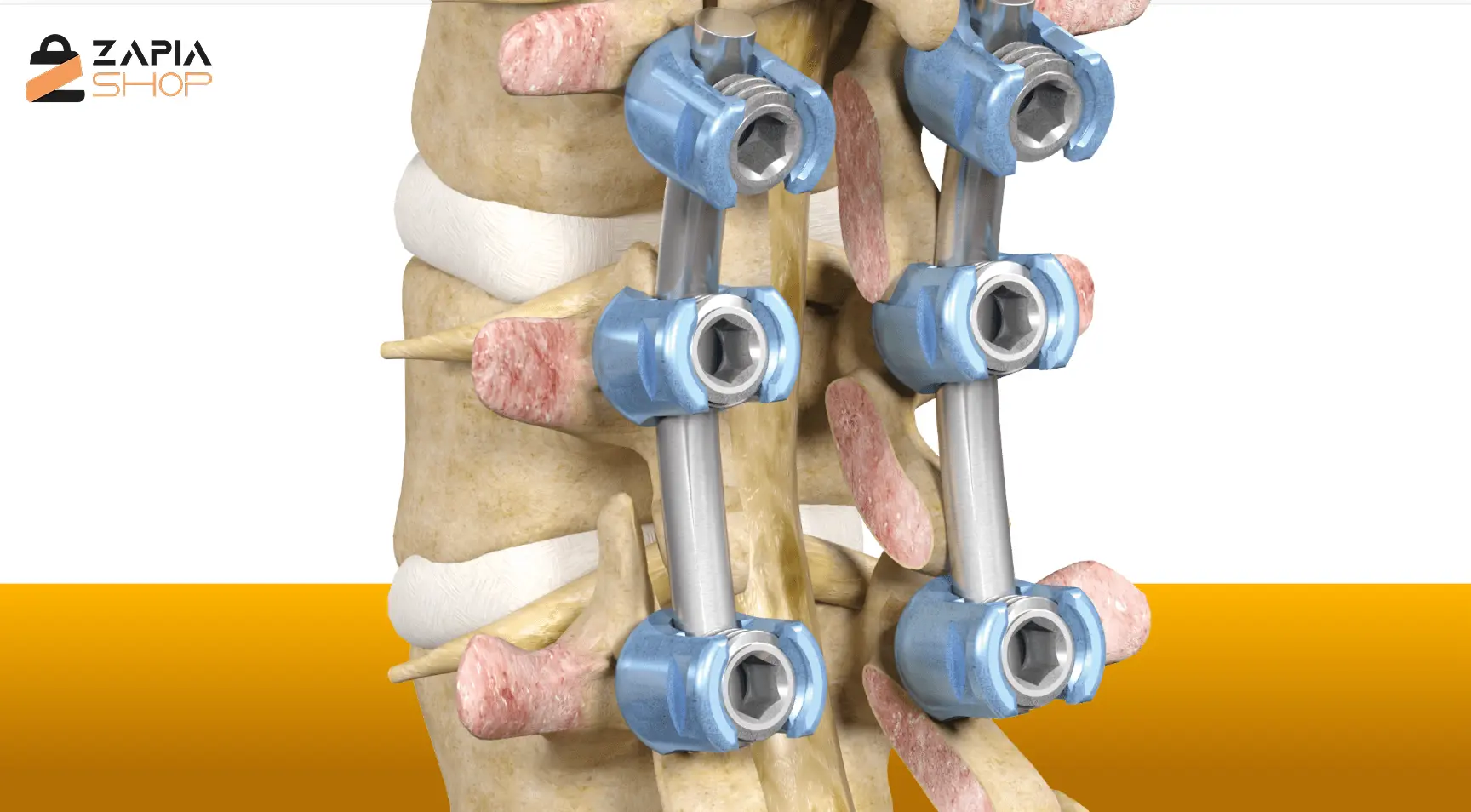 عمل فیوژن تنگی کانال نخاعی